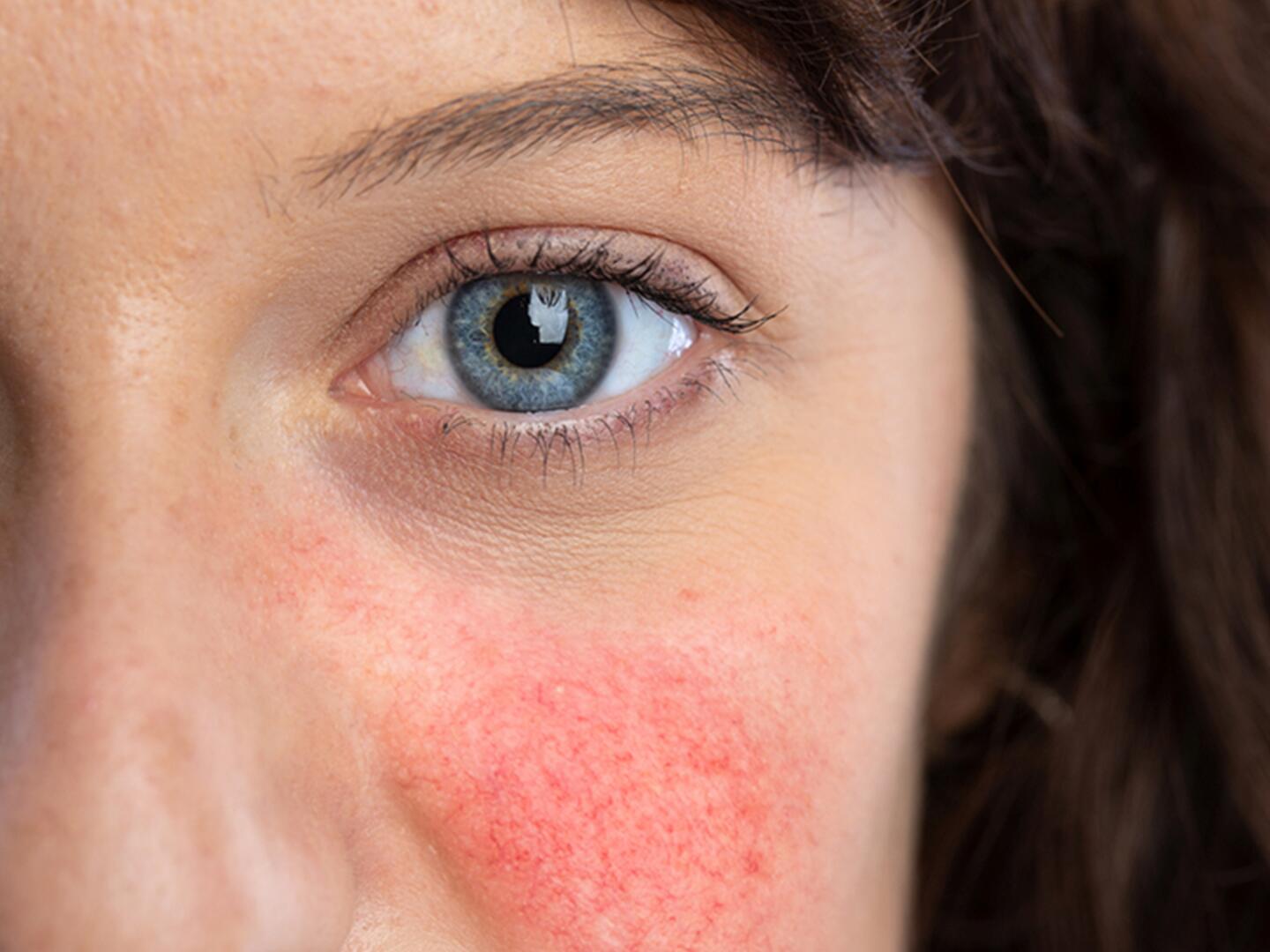 Rosacea: Darm als Schutzschild